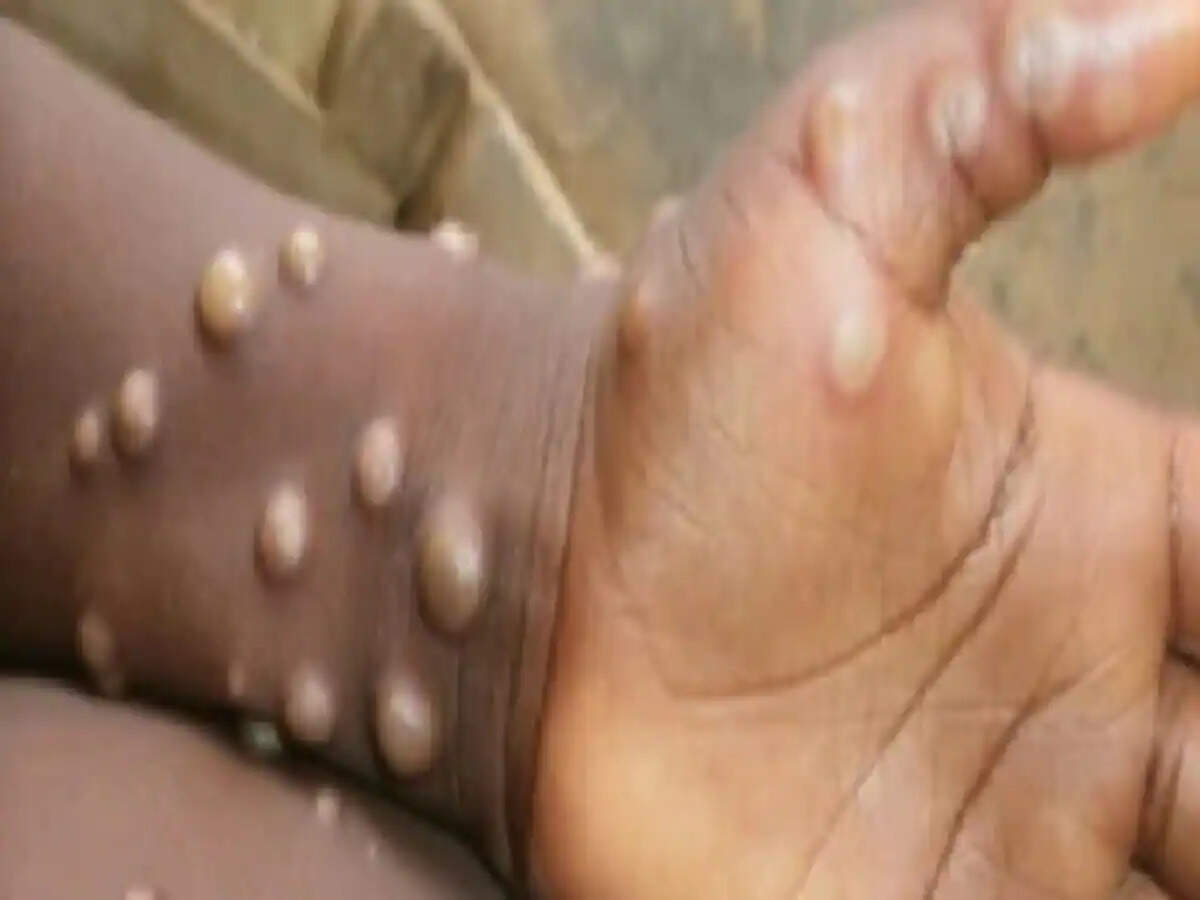 मंकीपॉक्स&nbsp;के&nbsp;तेजी&nbsp;से&nbsp;फैलने&nbsp;का&nbsp;कारण&nbsp;यह&nbsp;भी&nbsp;माना&nbsp;जा&nbsp;रहा&nbsp;है&nbsp;कि&nbsp;कोरोना&nbsp;गाइडलाइन&nbsp;हटने&nbsp;के&nbsp;बाद&nbsp;लोग&nbsp;लापरवाही&nbsp;में&nbsp;घूम&nbsp;रहे&nbsp;हैं